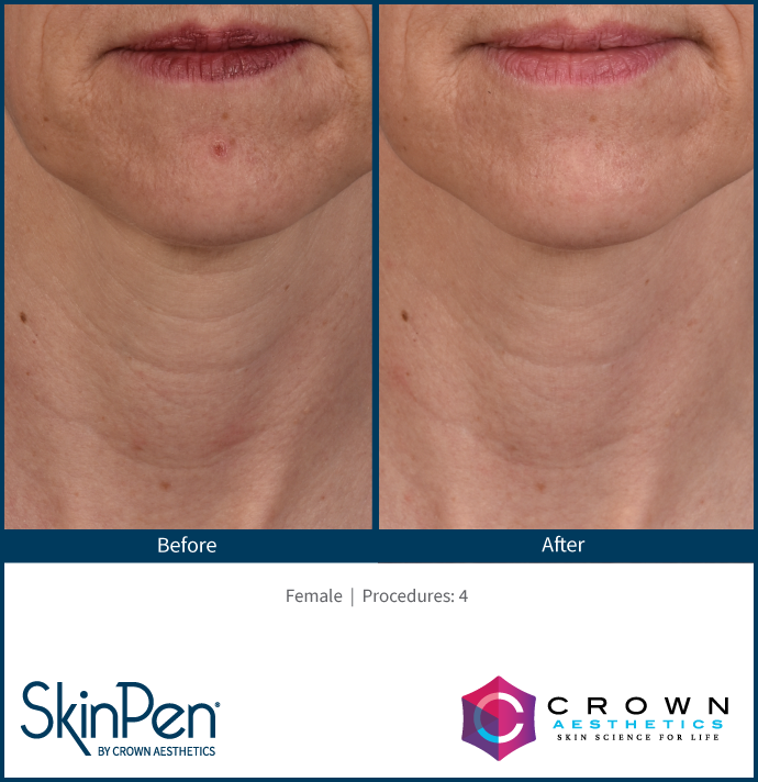 SkinPen At Advanced Oral And Facial Surgery Advanced Oral Facial
