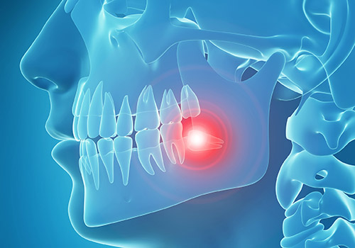 3d rendered, medically accurate 3d illustration of painful tooth