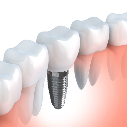Dental-Implants-sq