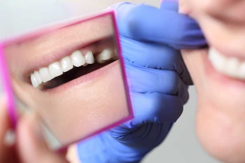 How Common is Dry Socket After Tooth Extraction?