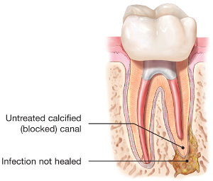 endodontic-retreatment