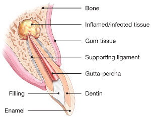 endodontic-surgery-diagram