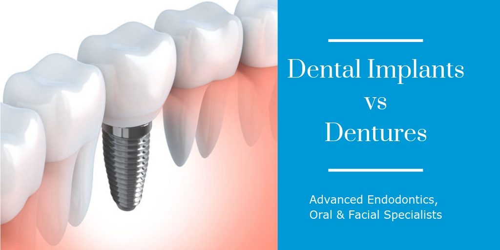 Advanced – DI vs Dentures (3)